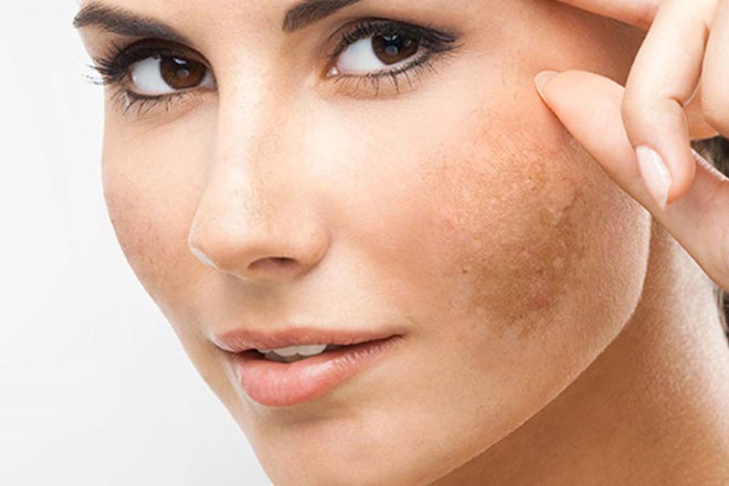 Serum Collagen Bio-H Stem Cell Kem Trị Nám Vi Diệu Dành Cho Bạn