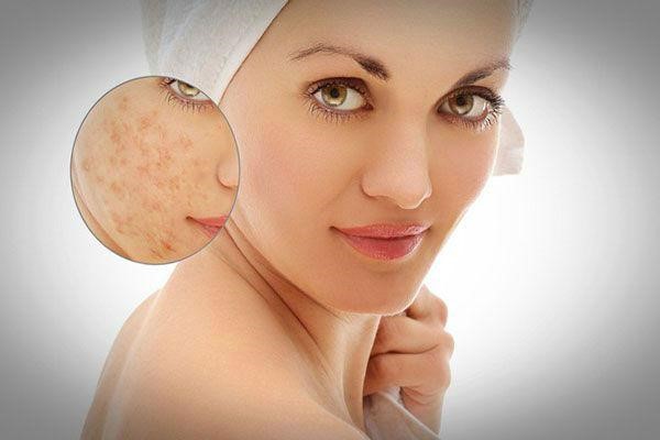 Serum Trị Sẹo Rỗ Hot Nhất